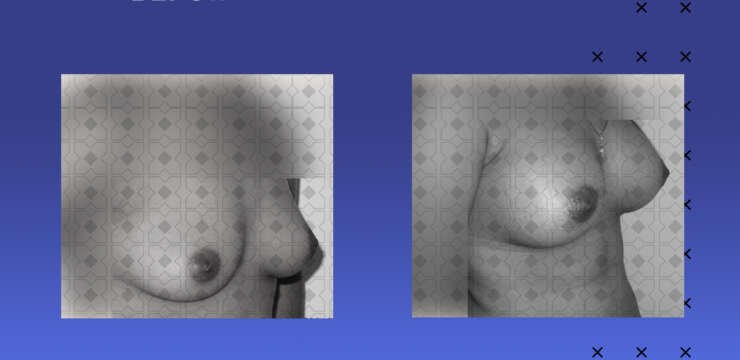 breast augmentation in kerala