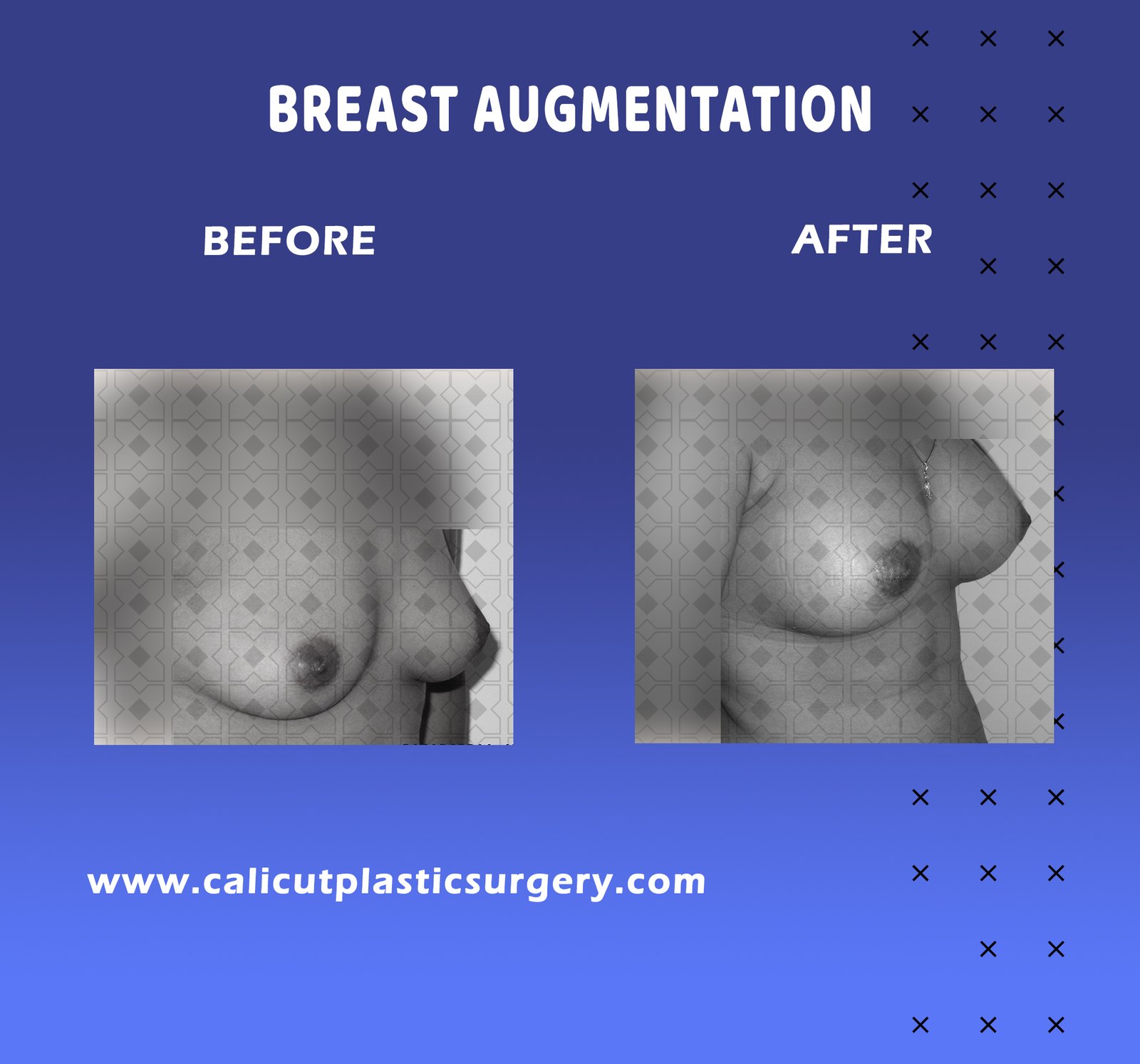 Breast Augmentation