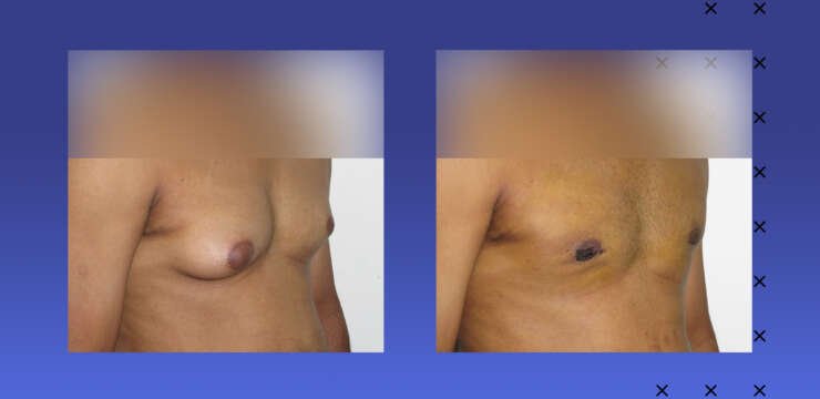 Man boobs gynecomastia surgery cost