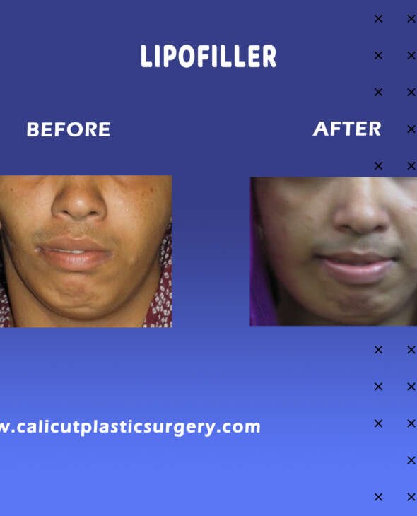 Fat Injection Surgery Lipo fiiller