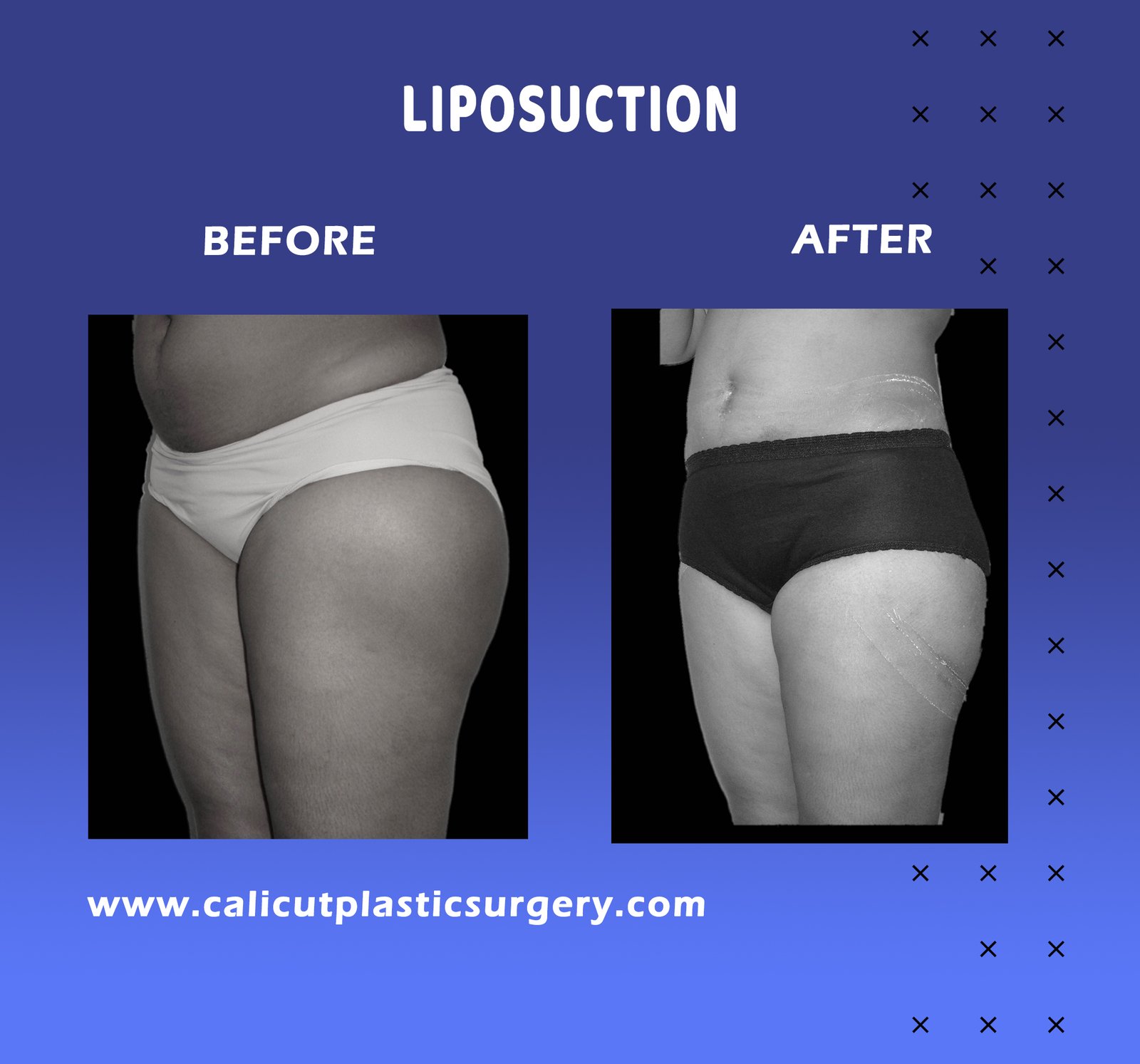 Liposuction