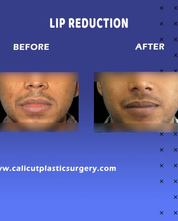 lip reduction Surgery in Calicut, Kerala