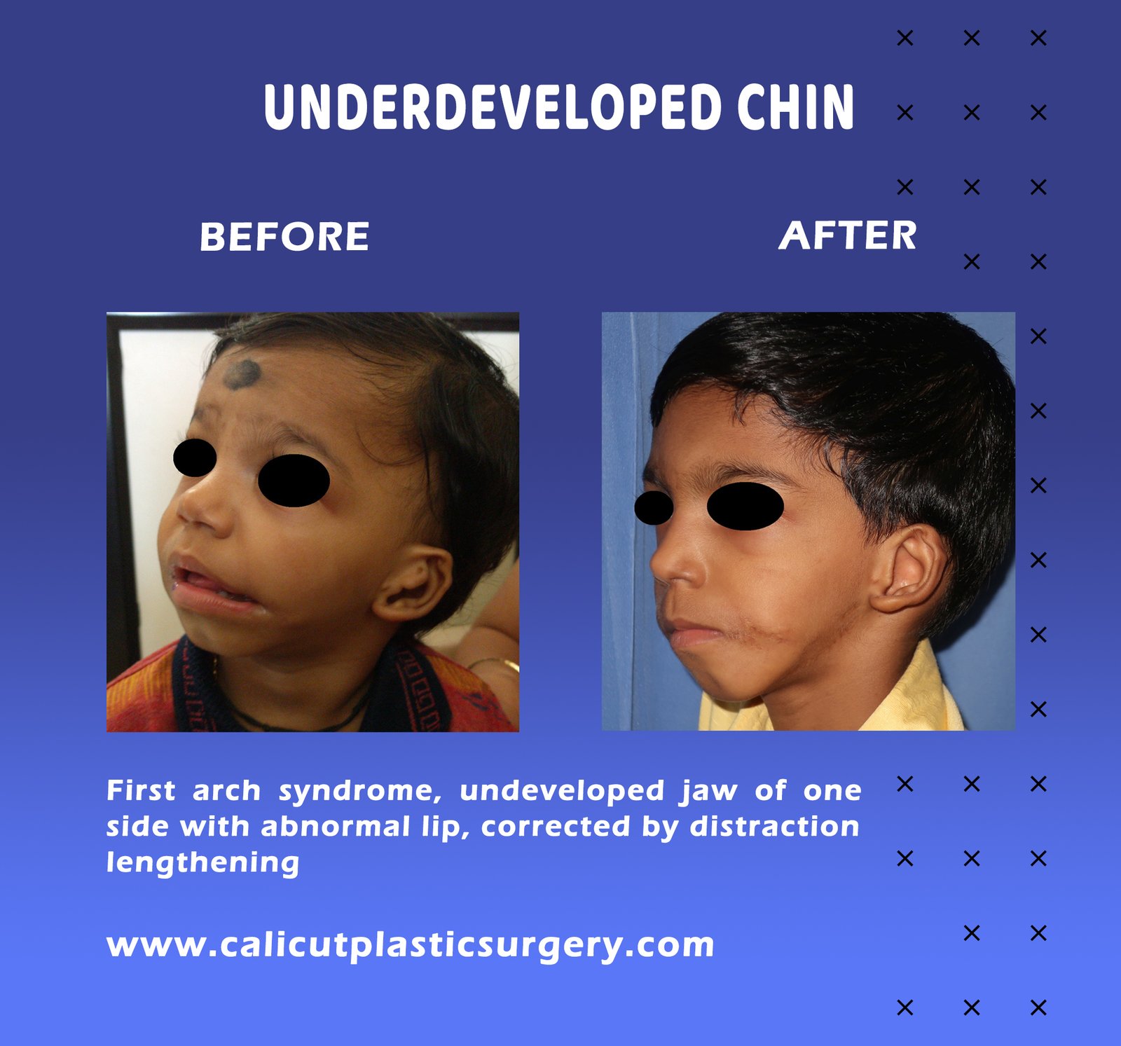 Facial Re-Animation Surgery