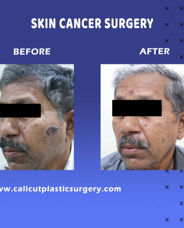 Skin cancer treatment in india