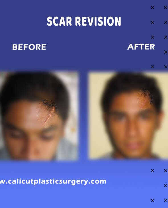 Scar Revision surgery treatment in India