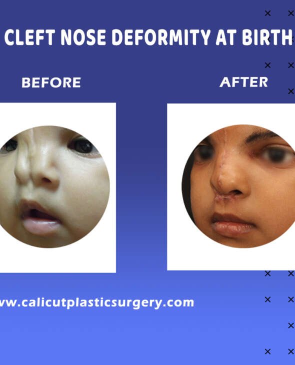 Nose Surgery