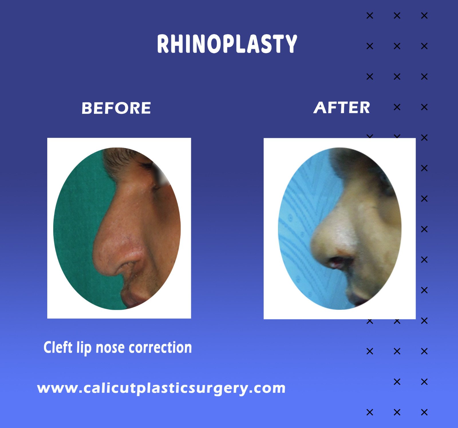 Rhinoplasty Nose Surgery